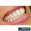 DMG 909765 - REGISTRO OCLUSAL O BITE 2 UN (DMG) - 1